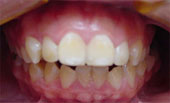 Caso Ortodoncia y Cirugia Maxilofacial