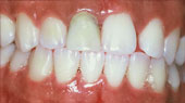 Caso Periodontitis Agresiva